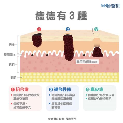 臉部 痣|痣變大、痣多或長毛會變皮膚癌？認識痣的形成與原因